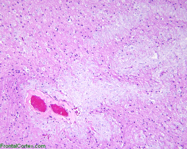 Amygdala, H&E stained section
