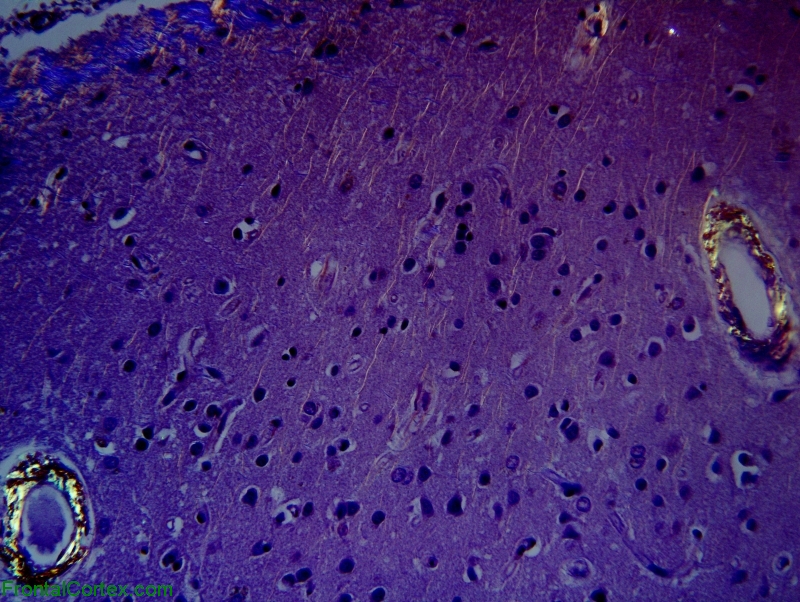 Amyloid Angiopathy, Congo red stain with polarization.