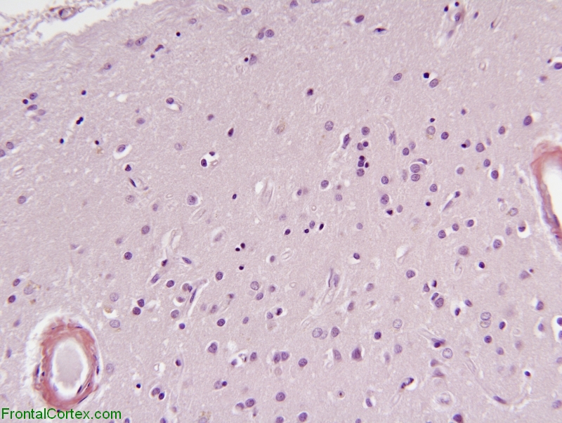 Amyloid Angiopathy, Congo Red stained section