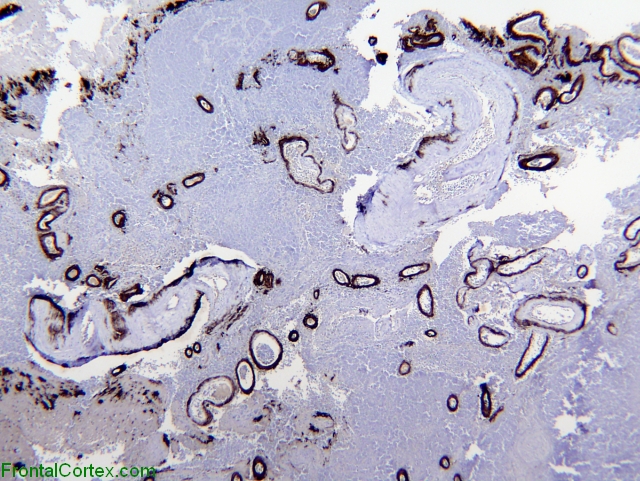 Amyloid Angiopathy, immunohistochemical staining for beta amyloid, low power.