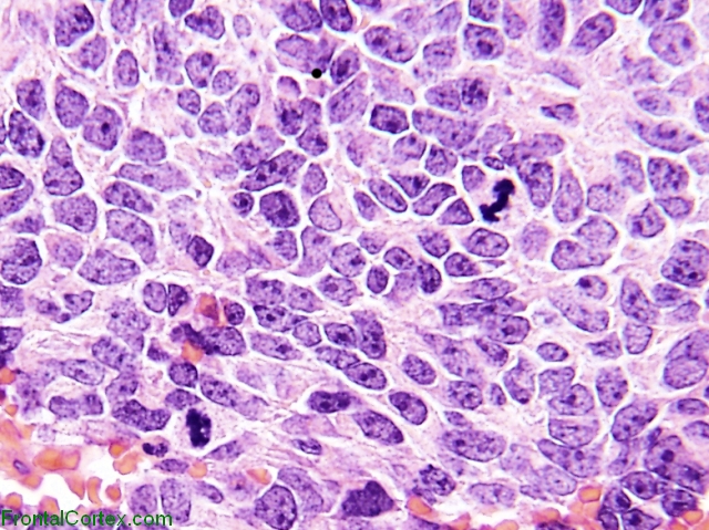 Medulloblastoma, large cell anaplastic variant, H&E stain slide x 400