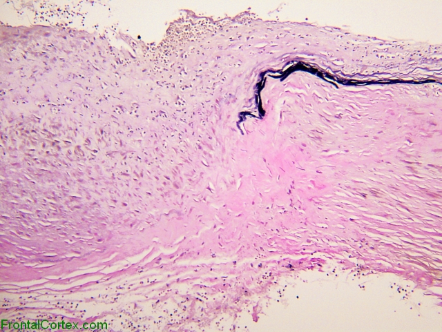 Aneurysm wall, histochemical staining for elastin.