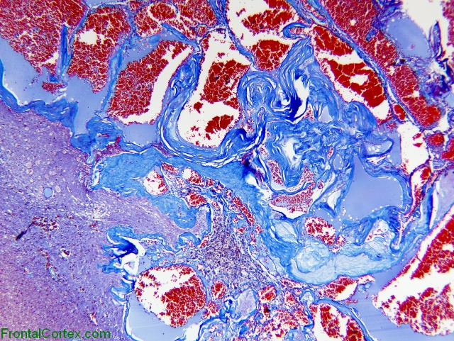 Cavernous angioma, trichrome stained section x 40