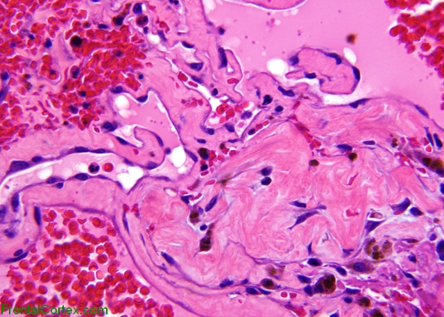 Cavernous angioma, H&E stained slide x 400