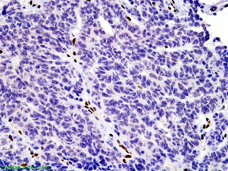 Atypical Teratoid Rhabdoid Tumor