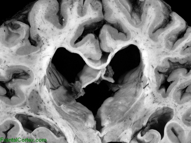 Bilateral perisylvian ulegyria with periventricular nodular heterotopias, coronal section of brain.