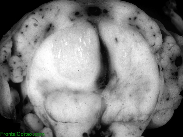 Brainstem Gliomain Spinal Cord T