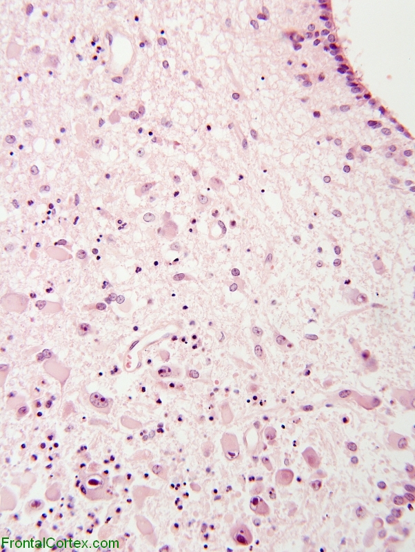 AIDS-related subependymal infection with enlarged cells demonstrating intranuclear inclusions, H&E stained section x 100