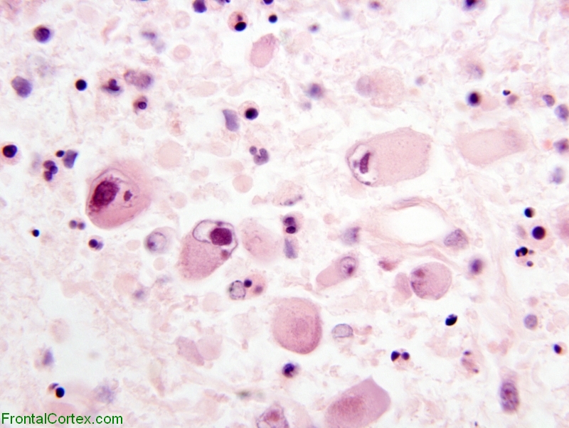 Cytomegaloviral infection, H&E stain X600