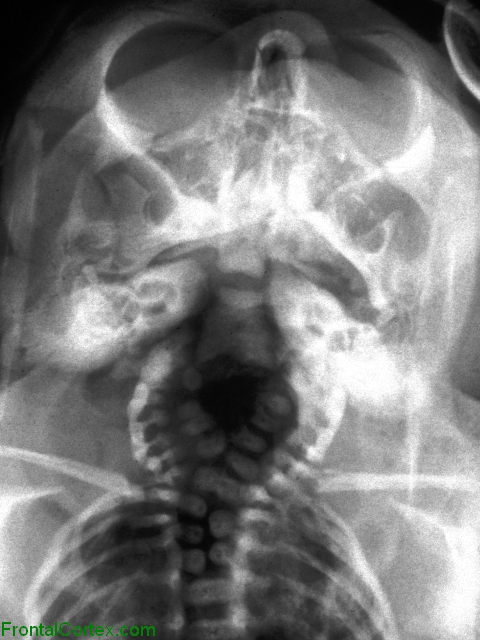 Craniorachiscisis totalis, fetal x-ray