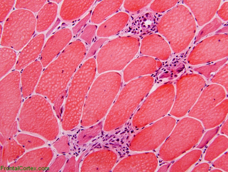 Calpainopathy, frozen section of muscle, H&E stain x 200.