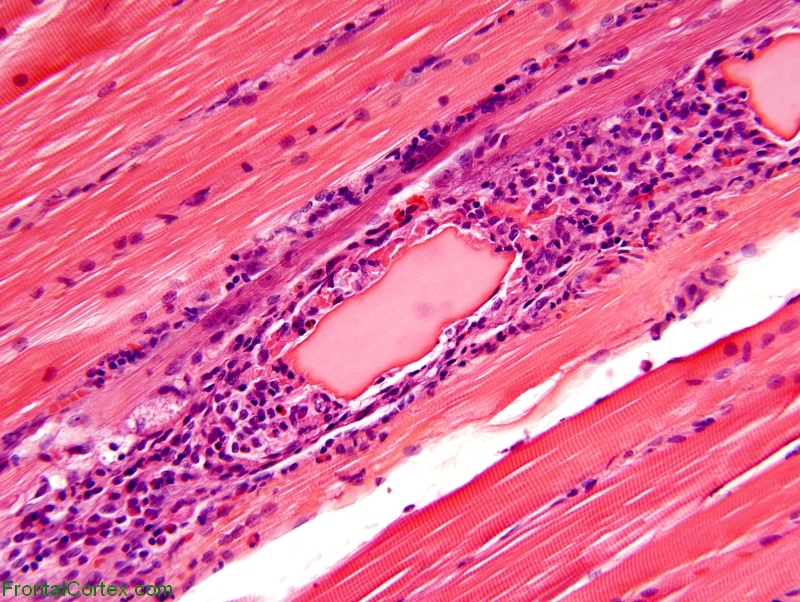 Calpainopathy, paraffin-embedded H&E stained section of muscle x 200