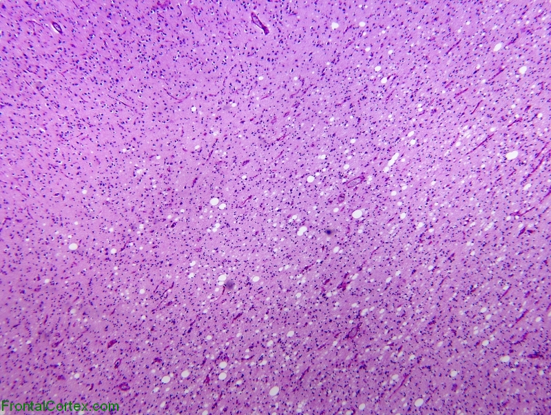 Canavan Disease, gray white junction, PAS stained section