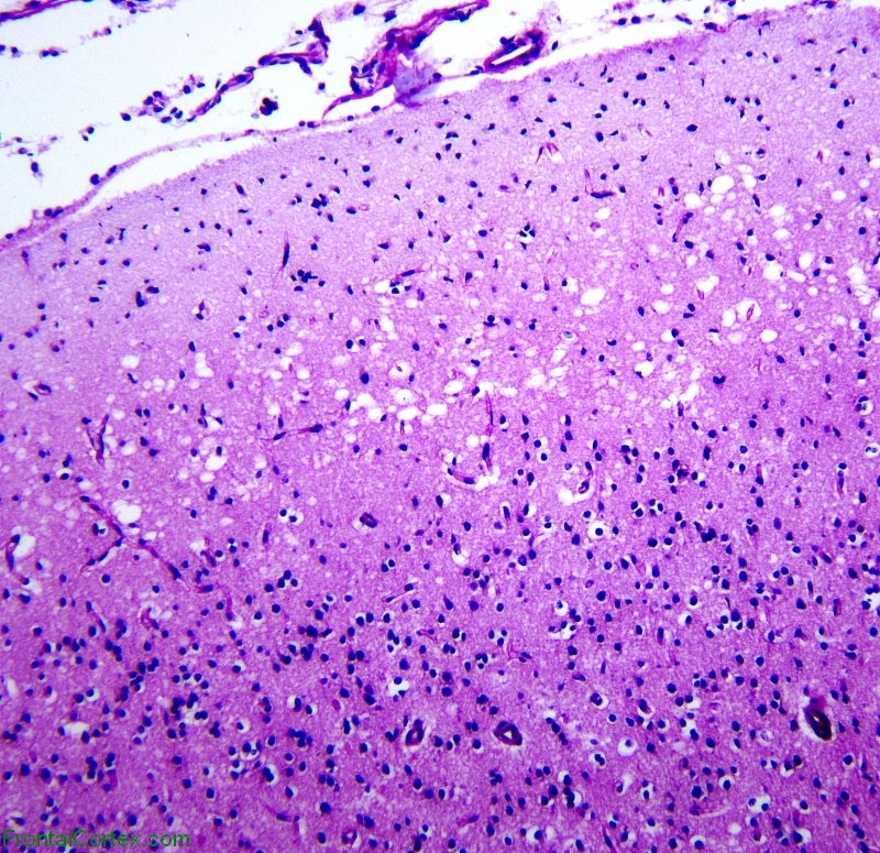 Canavan disease, high powered PAS stained section of cerebral cortex