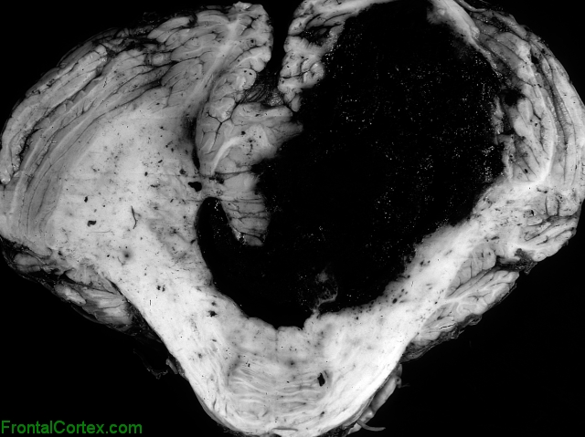 Ceerebellar Hemorrhage, transverse section through the cerebellum and Pons