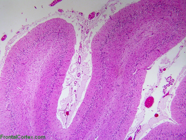 Cerebellar degeneration, H&E stained section x 20