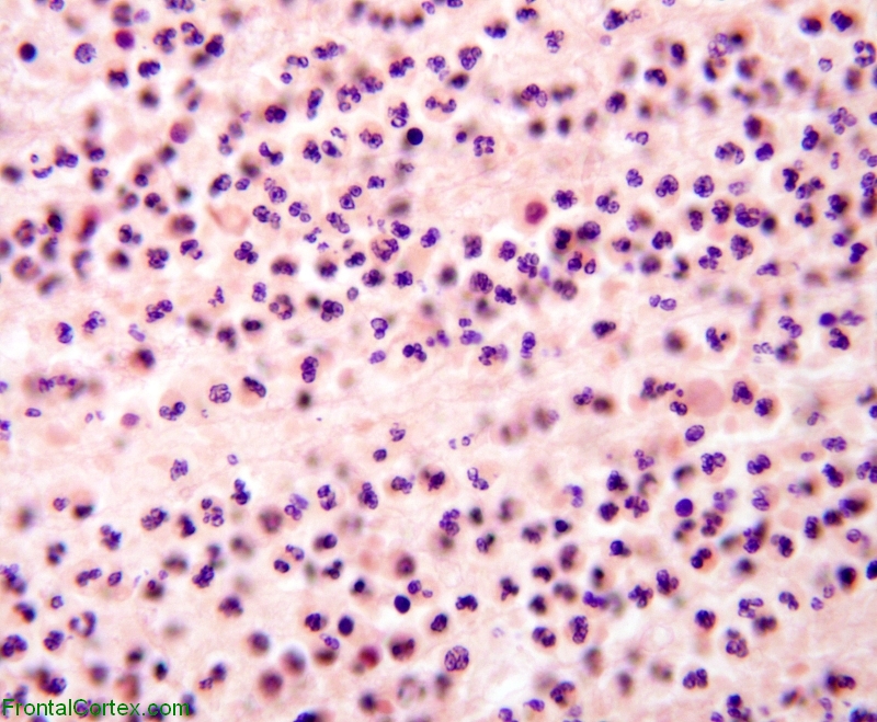 Acute cerebritis, high power H&E stained section