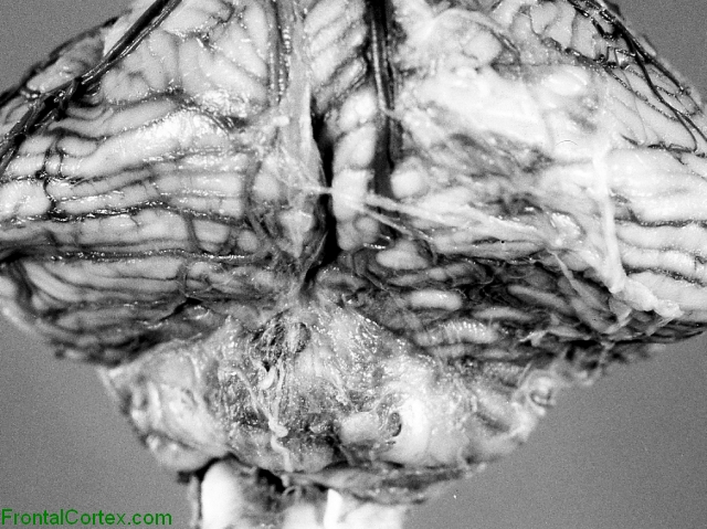 Chiari II malformation, dorsal surface of cerebellum