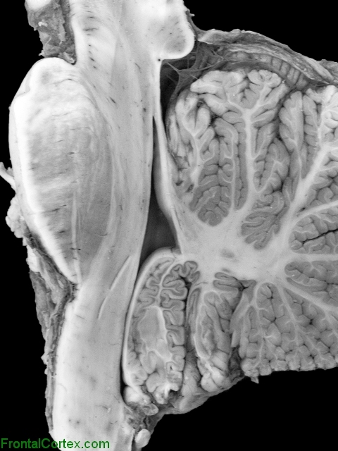 Chiari II malformation, mid sagittal section through cerebellum and brainstem