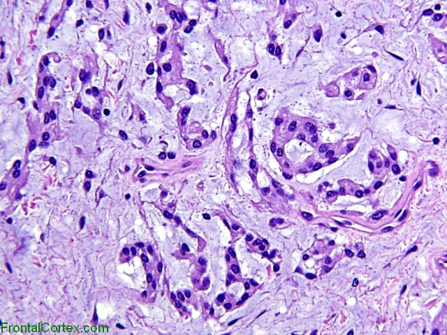 Chordoid Meningioma (WHO Grade II), H&E stained section, high power view.