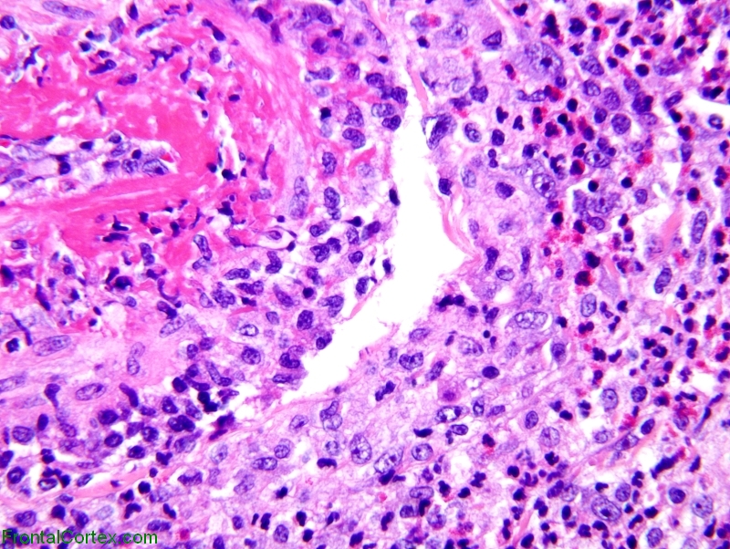 Churg-Strauss arteritis, H&E stained section x 400