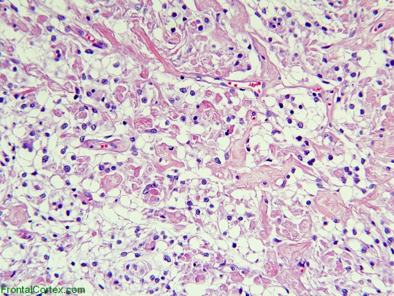 Clear Cell Meningioma, high power H&E stained section