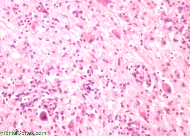 West nile virus myelitis, H&E stained section