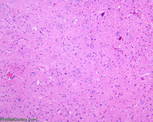 Cortical Tuber, low-power hematoxylin and eosin stained section
