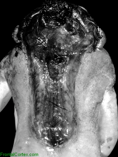 Craniorachiscisis totalis, dorsal view of fetus