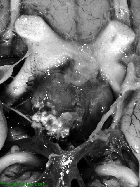 Craniopharyngioma, ventral surface of brain, close-up