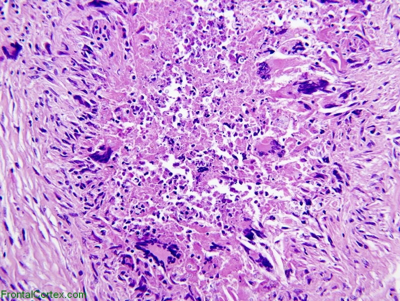Cryptococcoma, H&E stain section, high power