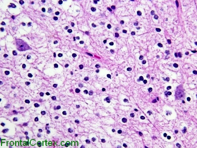 Dysembryoplastic Neuroepithelial Tumor, H&E stain