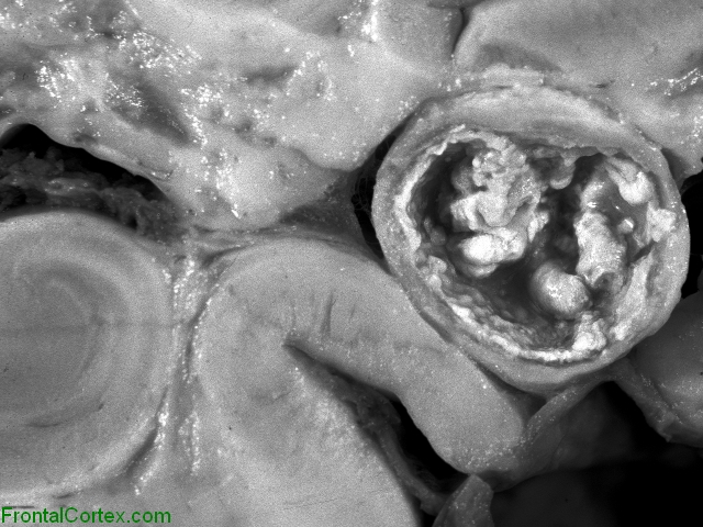 Echinococcal Cyst, temporal lobe of brain, coronal section, close-up