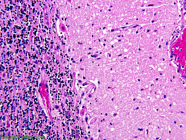 Eosinophilic Neuronal Degenerati