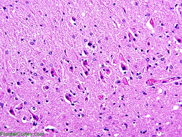 Eosinophilic Neuronal Degeneration, Hippocampus, H&E x200