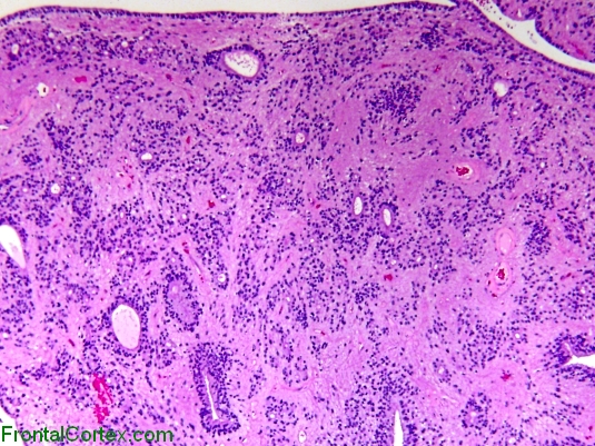 Ependymoma, low power H&E stained section