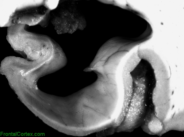 Frontotemporal lobar degeneration, coronal section of medial temporal lobe, close-up