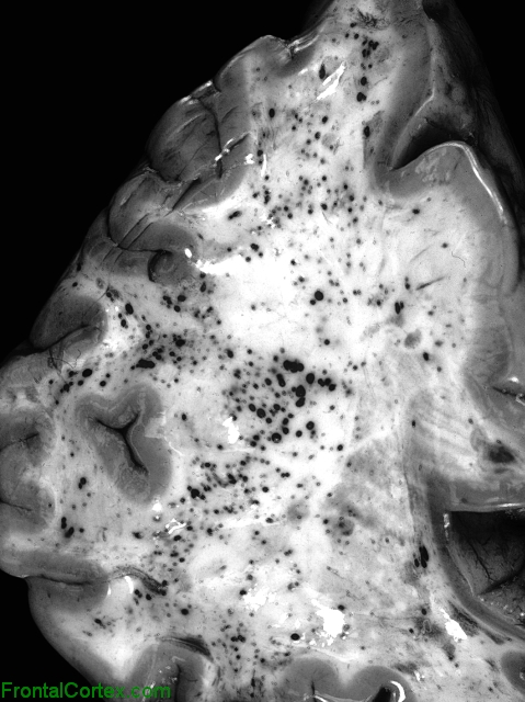 Fat Emboli, coronal section through unfixed frontal lobe