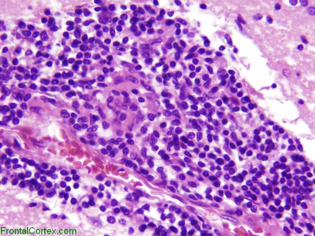 Primary angiitis of the central nervous system, high power H&E stained slide