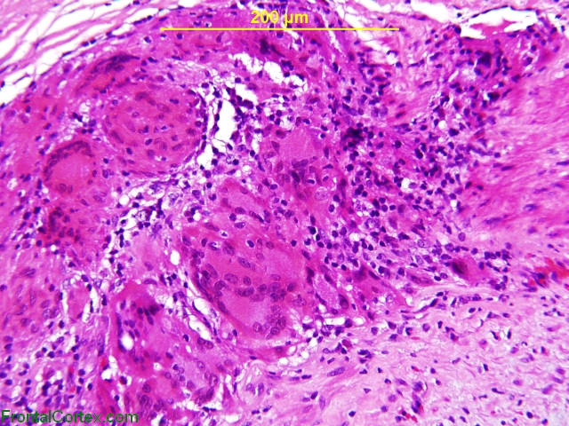 Giant Cell arteritis, H&E stained slide x200