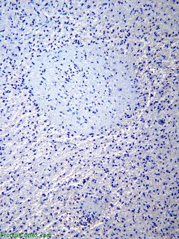 Glioneuronal Tumor with Neuropil