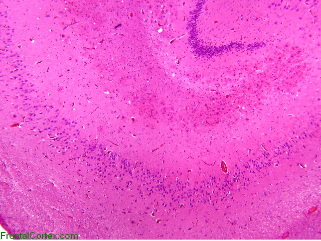 Gerstmann Straussler Scheinker disease, hippocampal formation, H&E stain, low-power