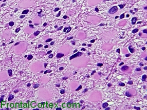 Gemistocytic astrocytoma, H&E stain x 100