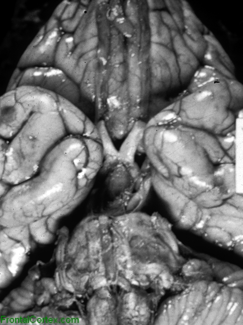 General paresis (paretic dementia), ventral surface of brain.