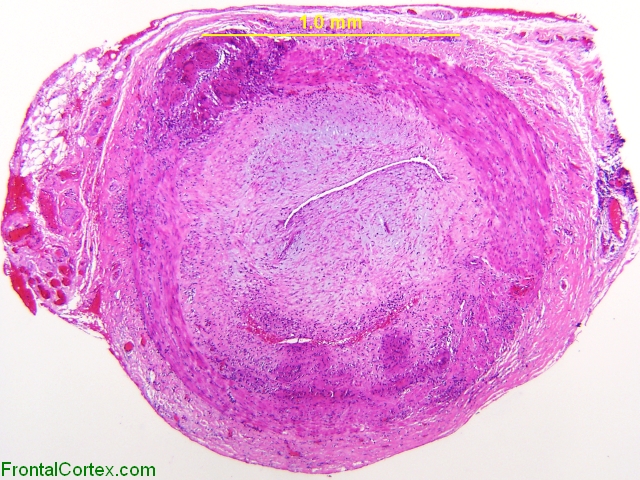 Giant Cell Arteritis, H&E stain x40