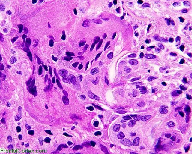 Giant Cell Arteritis, H&E stain x400