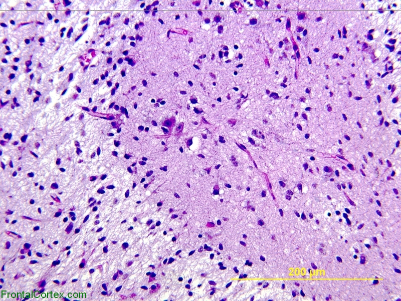 Glioneuronal Tumor with Neuropil Islands, H&E stain x 200