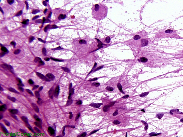 Granular Cell GBM Smear