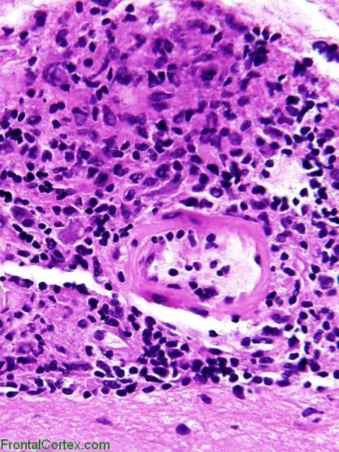Granulomatous meningitis in a patient with sarcoidosis, H&E stain x 200.