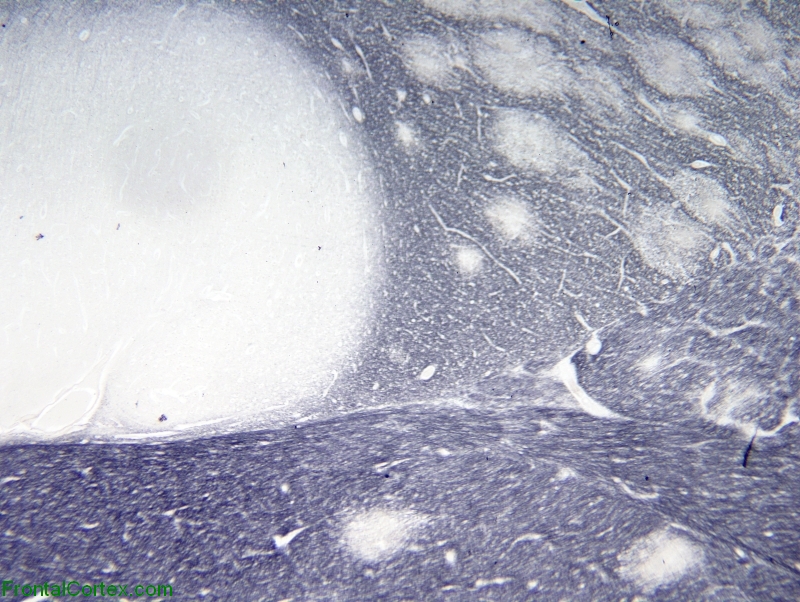 Grinkers Myelinopathy, crimbring stain for myelin